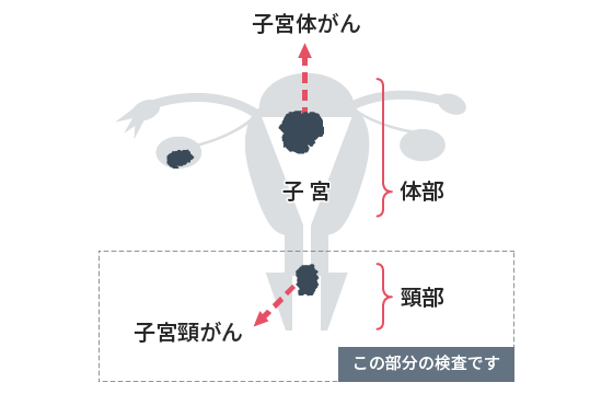 子宮頸がん検査(細胞診)