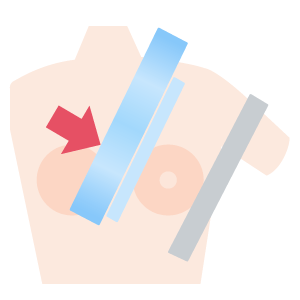 マンモグラフィー1方向