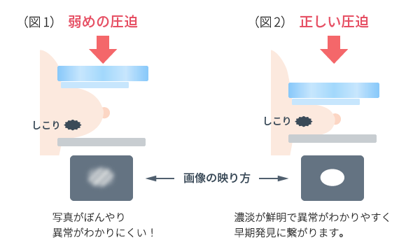マンモグラフィーの圧迫について